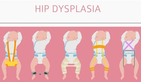 hip-dysplasia-infants